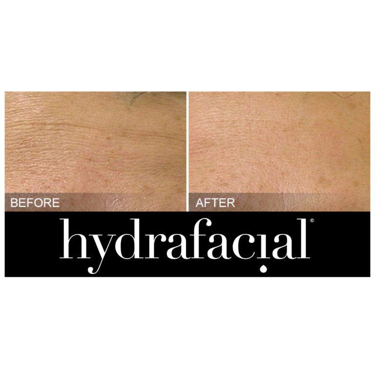 Hydrafacial fine lines 768x768
