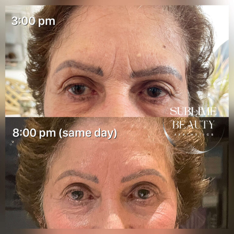 Botox  768x768